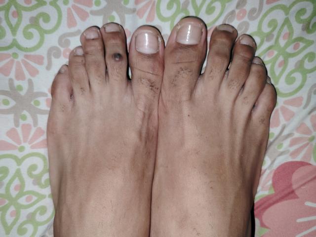 Jorzo's dirty feet with visible black and brown spots, slightly curved toes, and pinkish nail polish on a patterned surface.