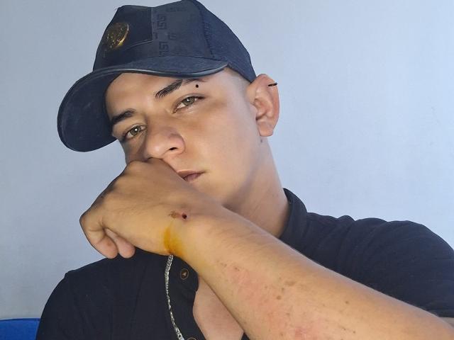 AntonyStelle, com uma expressão séria, usando um boné preto e uma camisa preta, segurando seu braço ferido, que apresenta uma pequena marca marrom-avermelhada, e uma leve vermelhidão na pele..