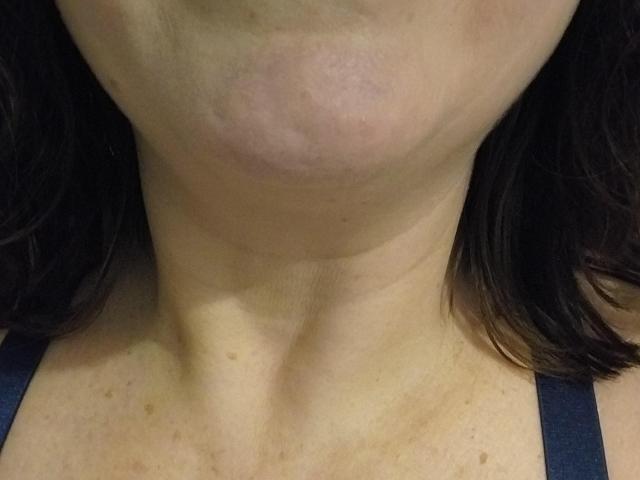 El cuello y la parte superior del pecho de LiliChattePoilue presentan un moretón púrpura notable en su lado izquierdo, que muestra su clavícula y su cabello ondulado de color marrón oscuro. Lleva una correa negra..