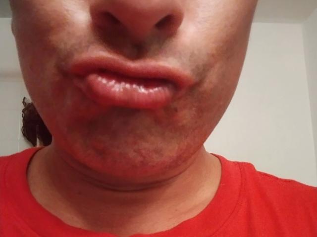 Leaveitinsideme-hot's gezicht met rode lippen, een licht gezwollen onderlip, en een rood shirt, waarbij wat huidtextuur en kleine oneffenheden zichtbaar zijn. Close-up, zonder zichtbare achtergrond..