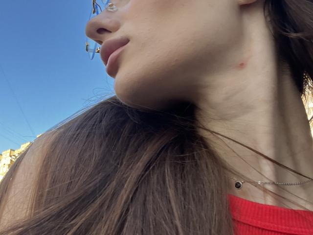 LadyJRouses' face with a small red bump on her neck, wearing glasses and a red top, her brown hair blowing in the wind, under a clear blue sky.