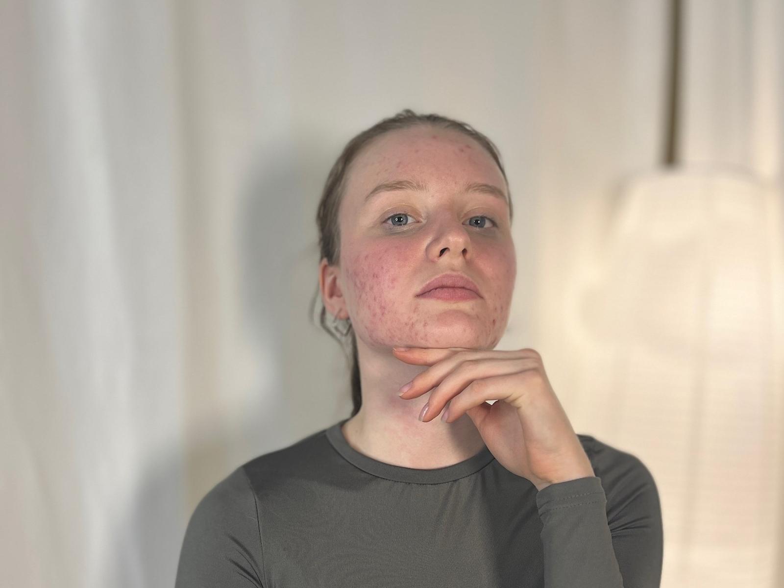 MargeneMatta, avec ses joues rouges et gonflées, portant une chemise grise à manches longues, a sa main sous son menton et regarde vers le haut avec une expression légèrement agacée..
