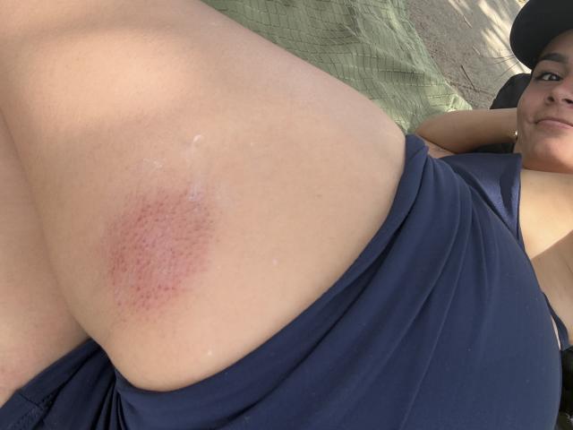 Close-up of KimmyK's upper thigh and lower torso. KimmyK is lying down, wearing a dark blue, sleeveless dress. A red, slightly inflamed, circular rash is on the inner thigh. KimmyK's right arm is resting above her head, and she's wearing a black hat. Her skin is light, and the texture of the dress is smooth. Sunlight casts shadows on her thigh and dress. The image focuses on the rash and KimmyK's relaxed position.