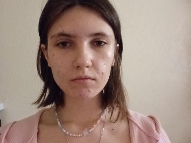 HuldaIckert has a serious face, light skin, brown eyes, and short brown hair. She's wearing a pink top and a pearl necklace, with visible acne on her cheeks.