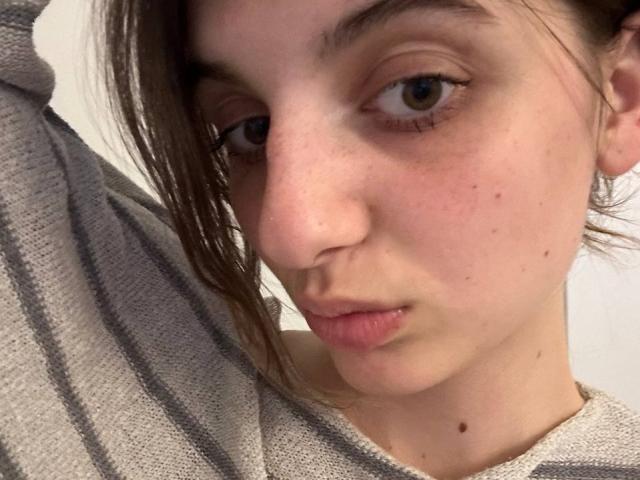 KarieMestler has a pimple on her nose, a small mole under her chin, and is wearing a grey striped sweater, with her brown hair partially covering her right eye.