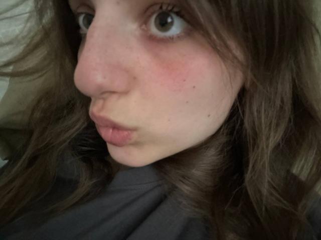 KarieMestler's puffy, red-assed face with brown wavy hair, wide green eyes, and slightly pursed lips, showing light freckles and small pimples, in a tight selfie shot.