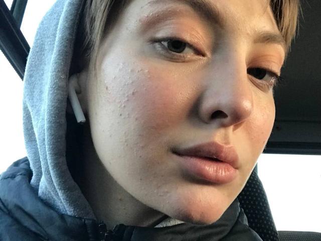 GigiWadkins has pimply, slightly flushed skin, full pink lips, and is wearing a grey hoodie with her brown hair partly visible. She's looking to the side with white earbuds.
