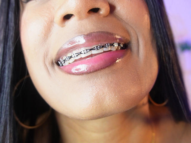 NatLewis's shiny pink lips with a metal grill over her teeth, dark brown skin, and straight black hair, wearing gold hoop earrings, shown from the nose down.