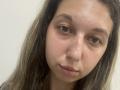 Sanella's face with light brown eyes, slightly parted lips, and long brown hair with blonde highlights. She has a few blemishes and a small red spot on her nose.